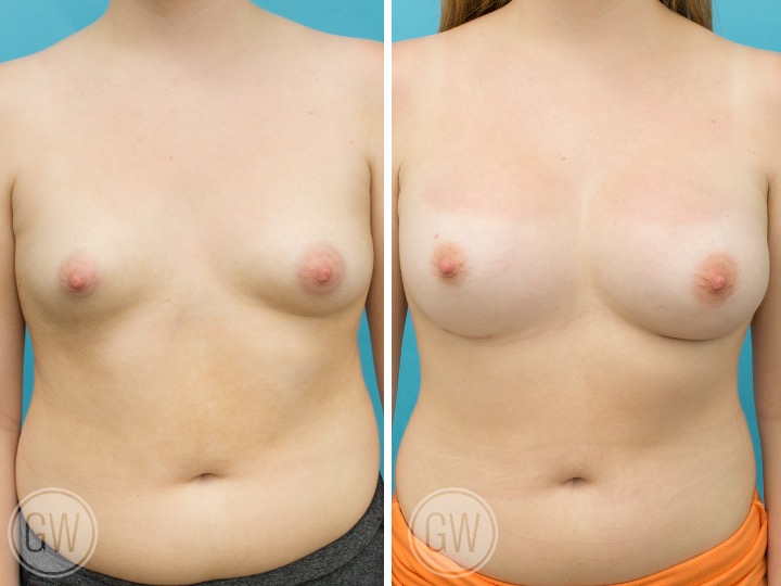 BREAST RESHAPING WITH FAT GRAFTING- Implant: 375cc/420cc
