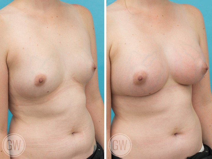 350cc Implant: 350cc Smooth Round, High Profile