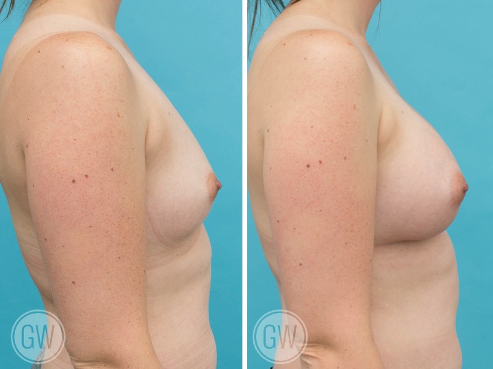 350cc Implant: 350cc Smooth Round, High Profile