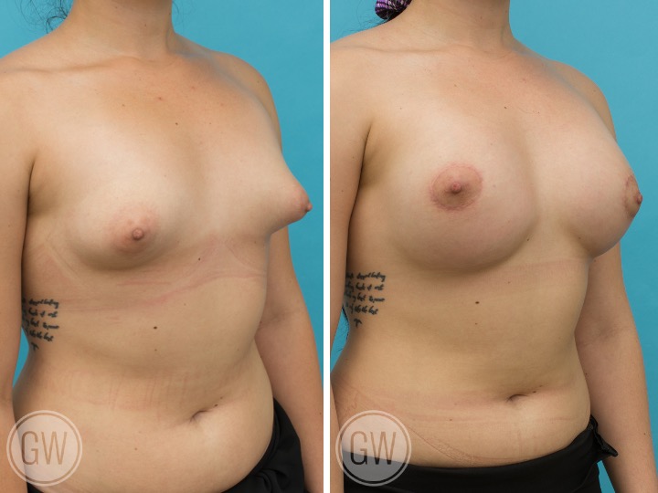 375cc Implant: 375cc Anatomical, Medium Height, Moderate Plus Profile + 30cc Fat Grafting per side