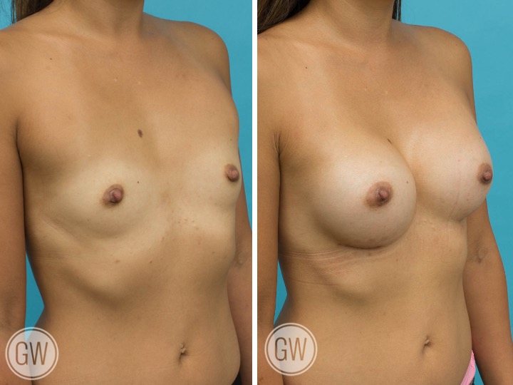 350cc Implant: 350cc Smooth Round, High Profile
