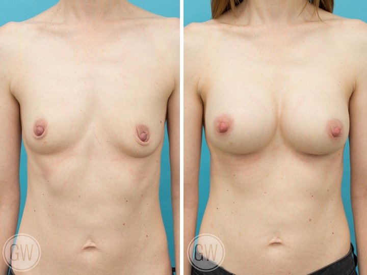 Anatomical Implants Gallery Before and After Image Dr Guy Watts