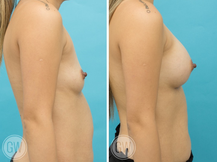 275cc Implant: 275cc Smooth Round, Full Profile