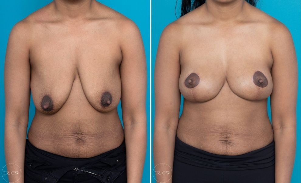 What Causes Sagging Breasts -Causes & Surgery for Breast Ptosis