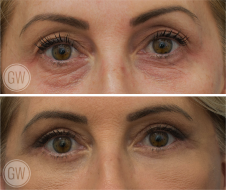 Anterior Neck Lift 6 Weeks Post-op