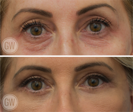 Say Goodbye to Hooded Upper Eyelids Blog Featured Image - Bleph13-e1538000343974