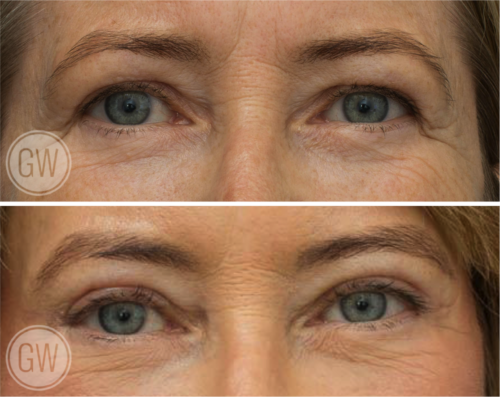 Anterior Neck Lift 3 Months Post-op