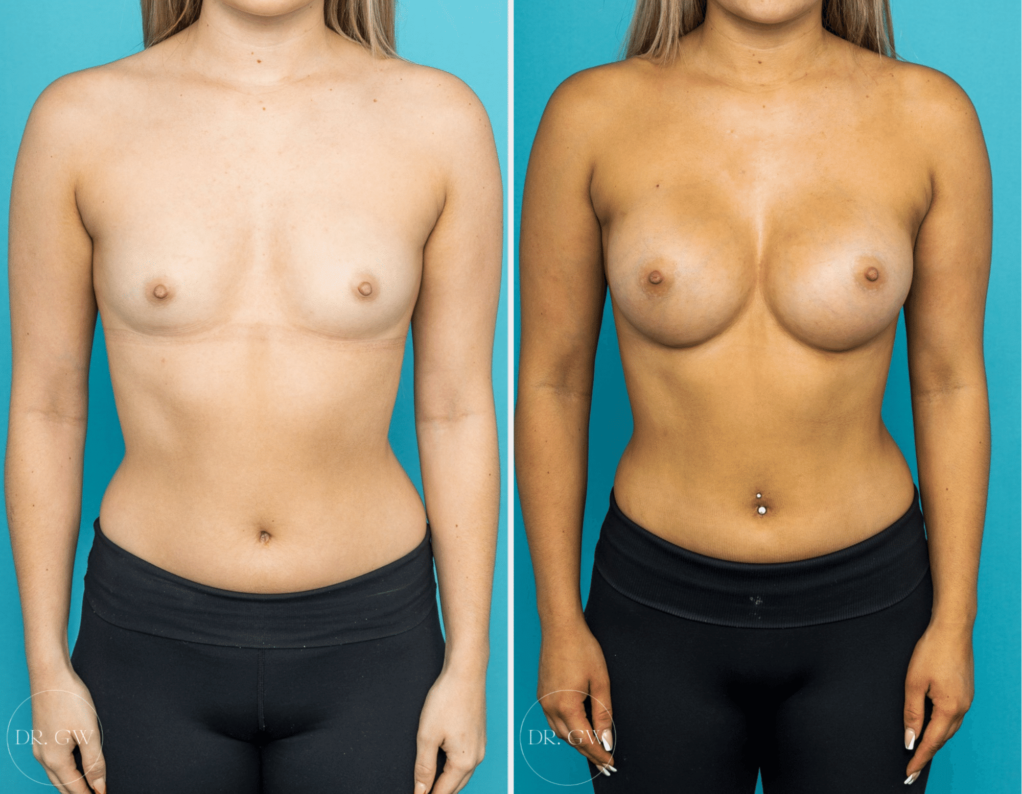 exercise after breast augmentation