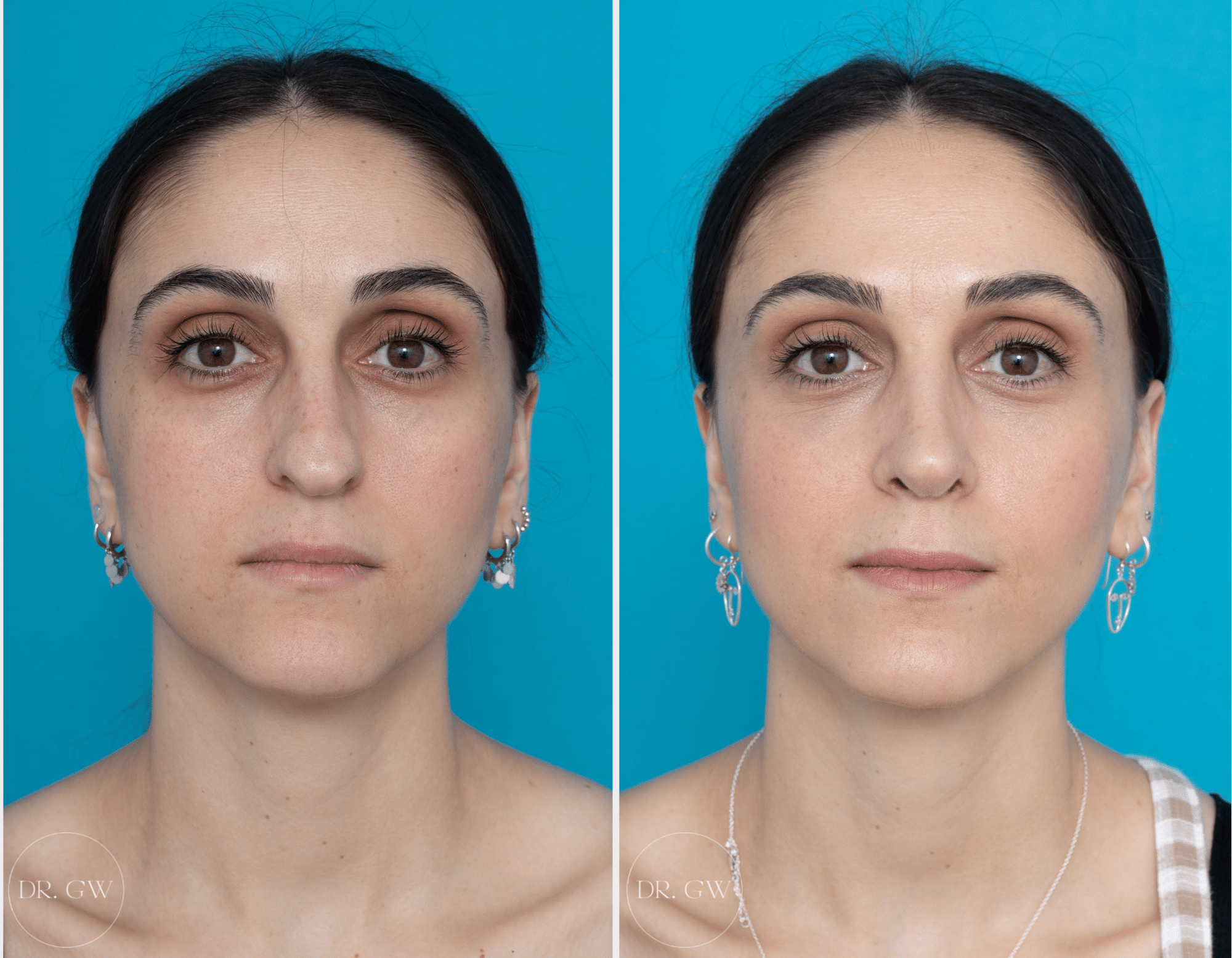 An Upturned Nose Can Be Corrected with Rhinoplasty