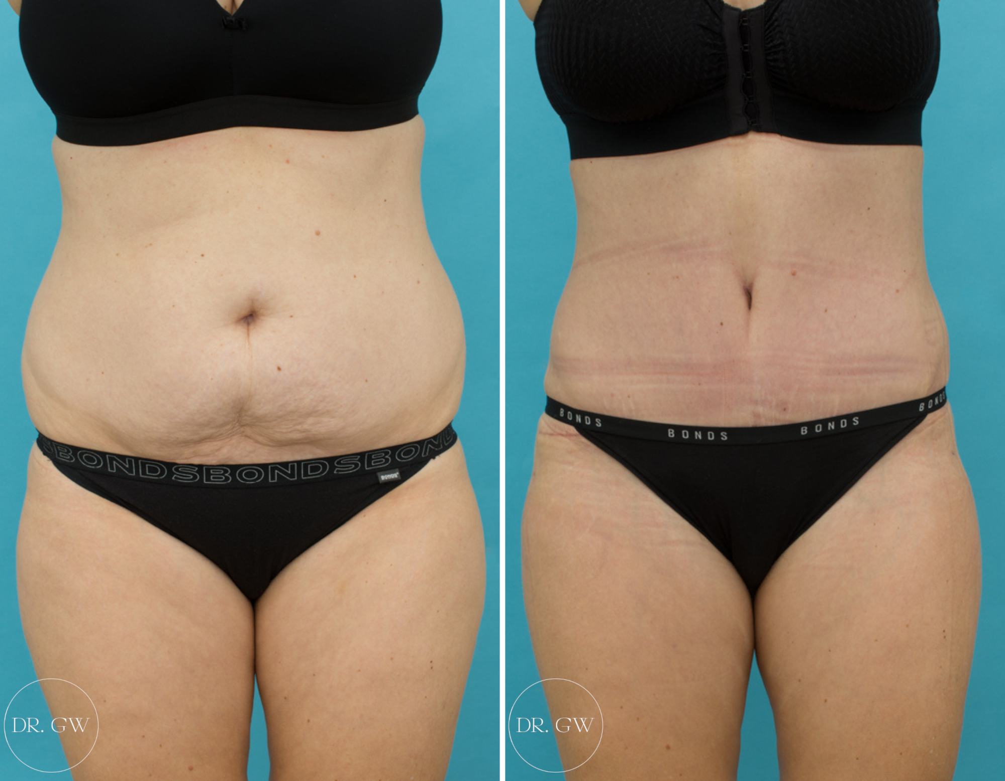 Abdominoplasty + 360 Liposuction