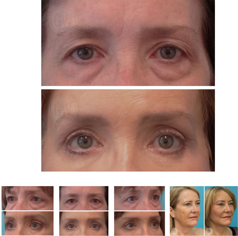 Gliding Brow Lift in Perth Featured Image small