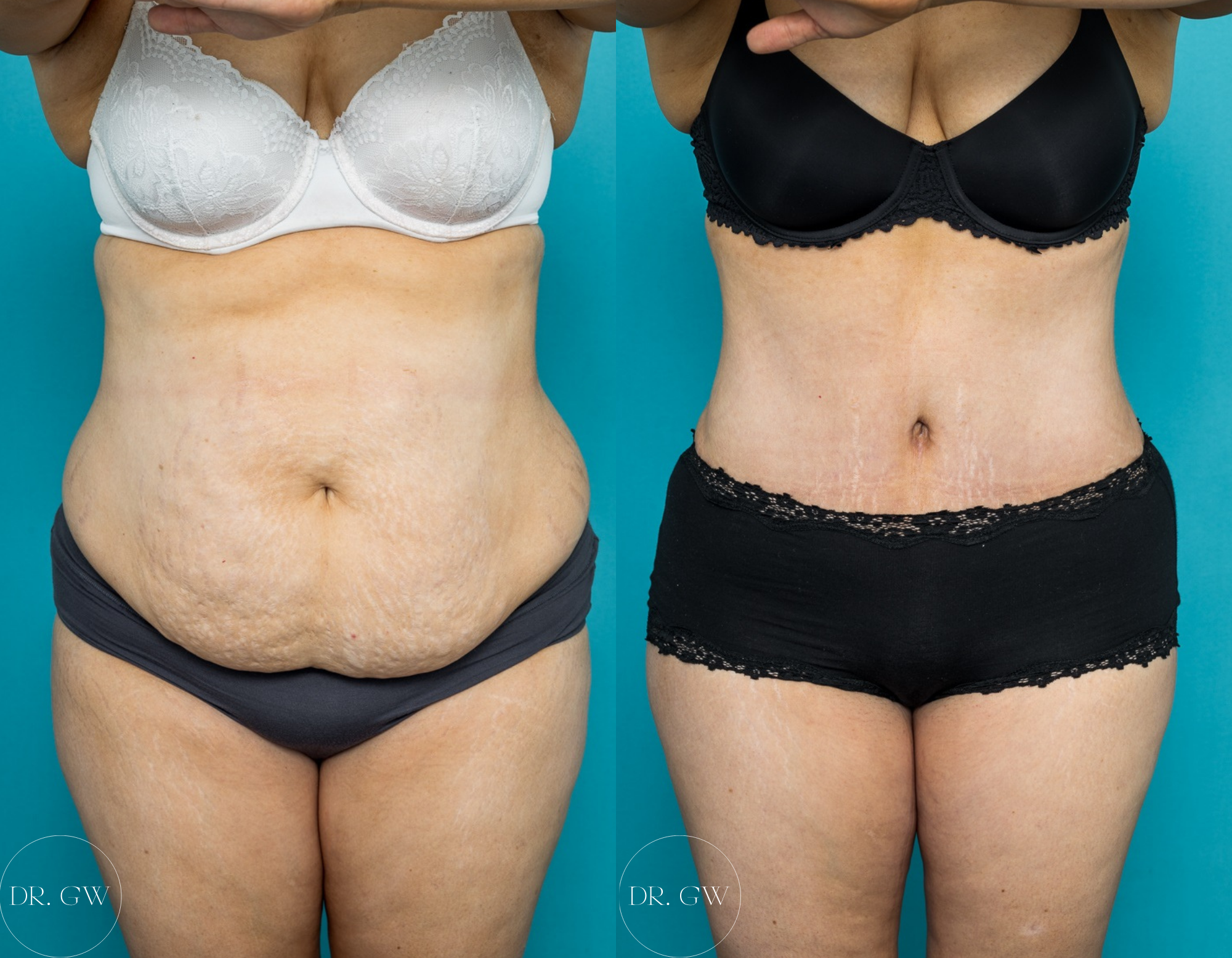 Abdominoplasty + 360 Liposuction 3 Months Post-op - Image GW