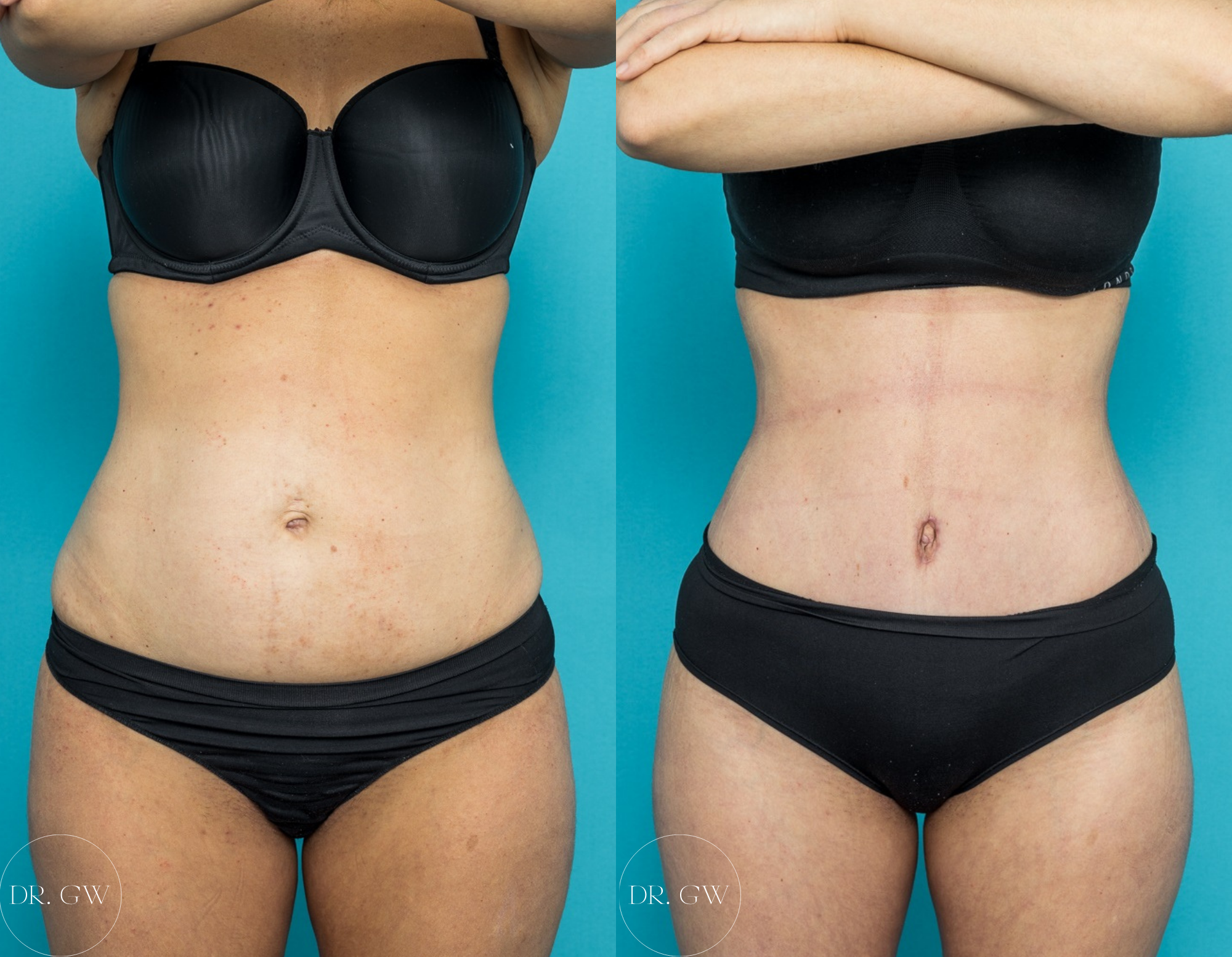 How to Reduce Bruising and Swelling After Tummy Tuck (Abdominoplasty) - Abdominoplasty + 360 Liposuction 3 Months Post-op