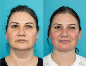 Anterior Neck Lift 3 Months Post-op