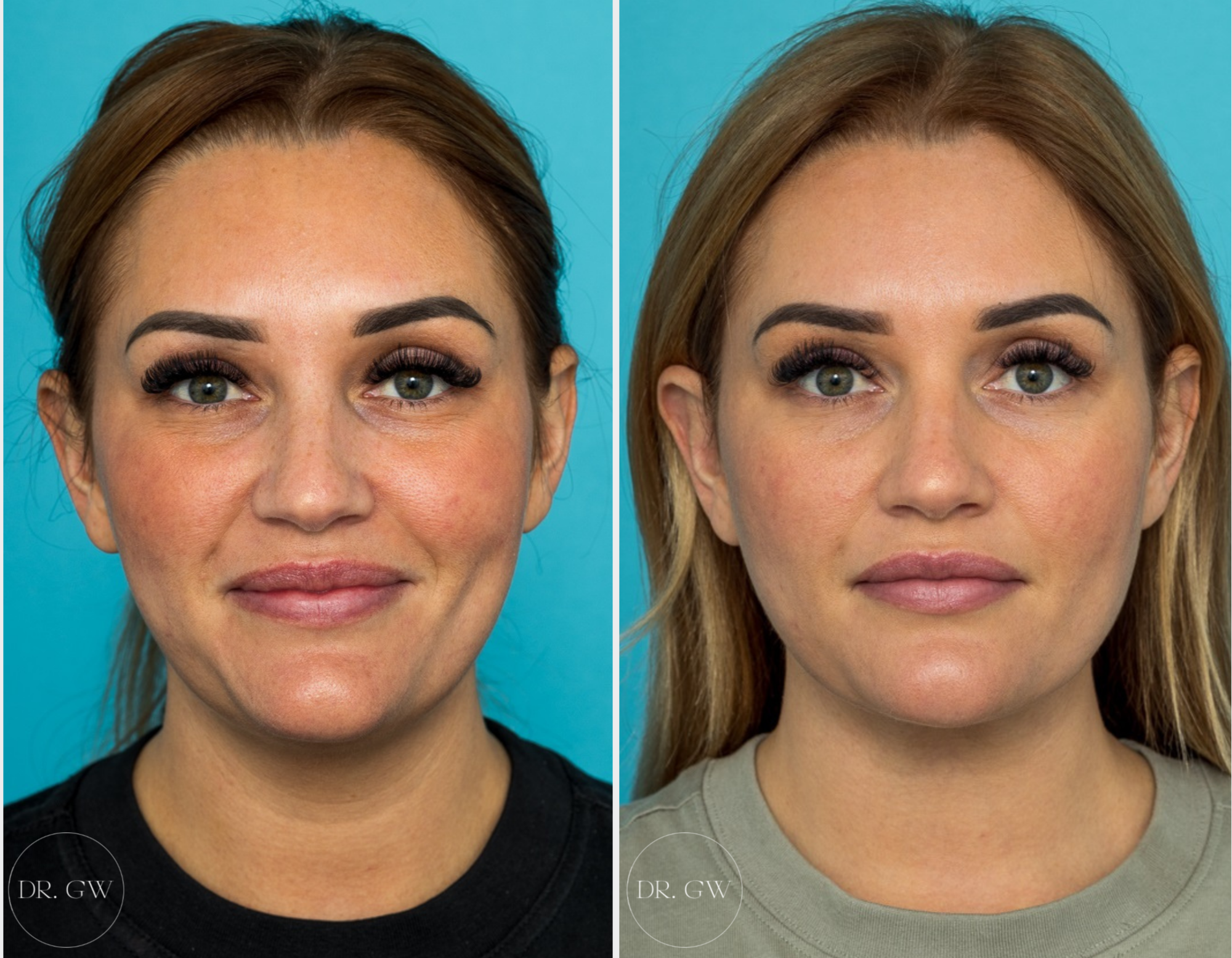 Anterior Neck Lift 6 Weeks Post-op