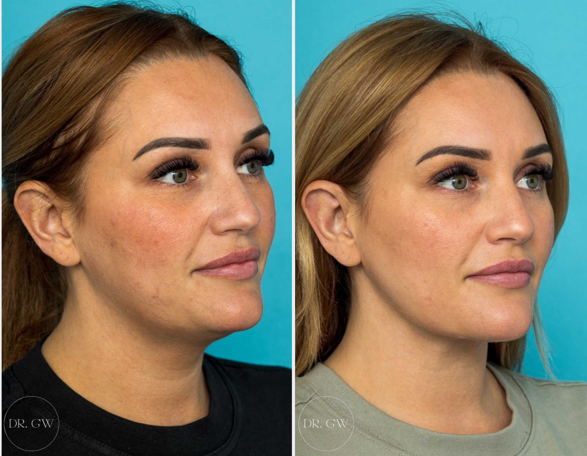 Anterior Neck Lift 6 Weeks Post-op