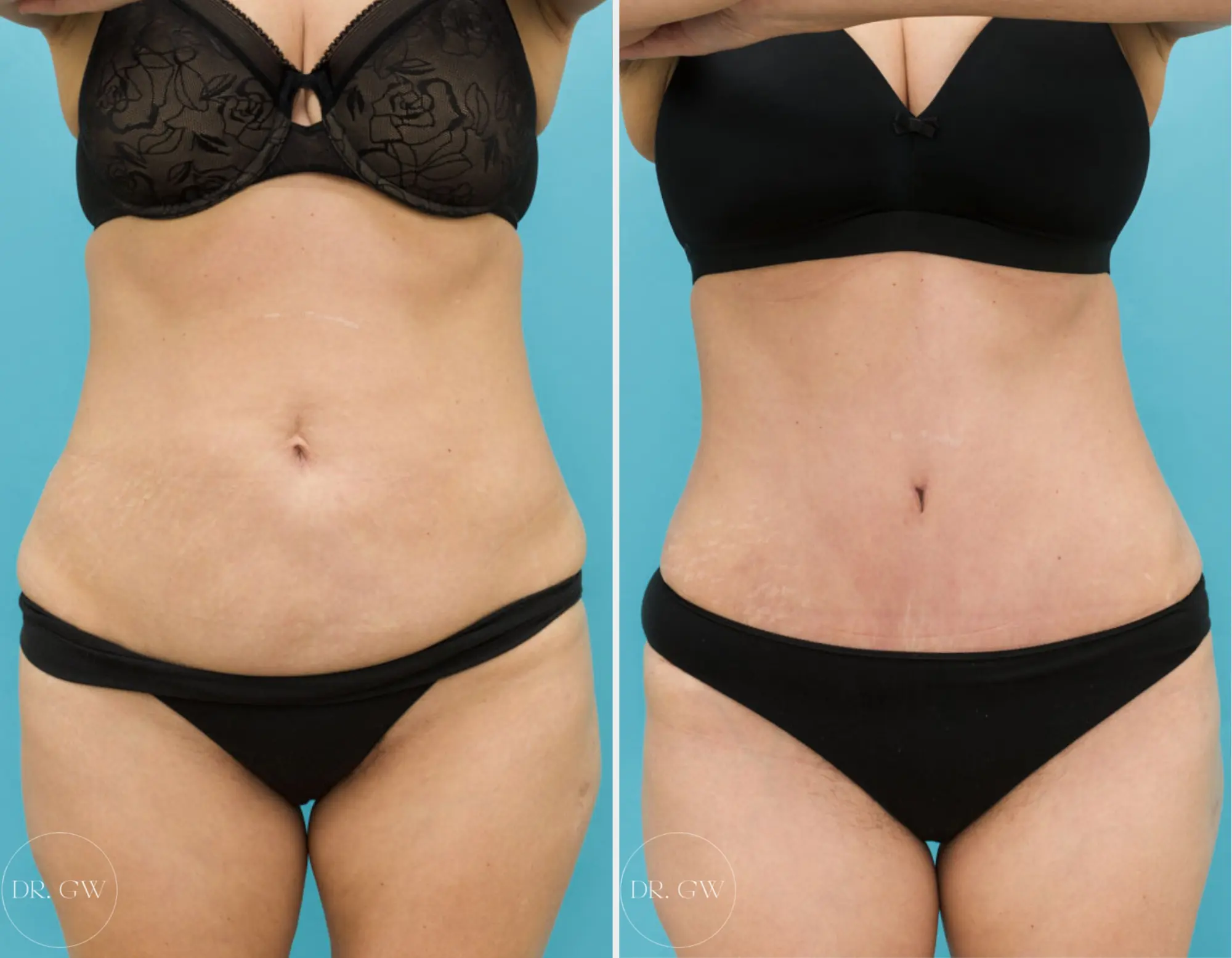 How to Get a Smaller Waist Featured Image - 1926 Pre-Abdominoplasty 360-Liposuction F Before and after Images