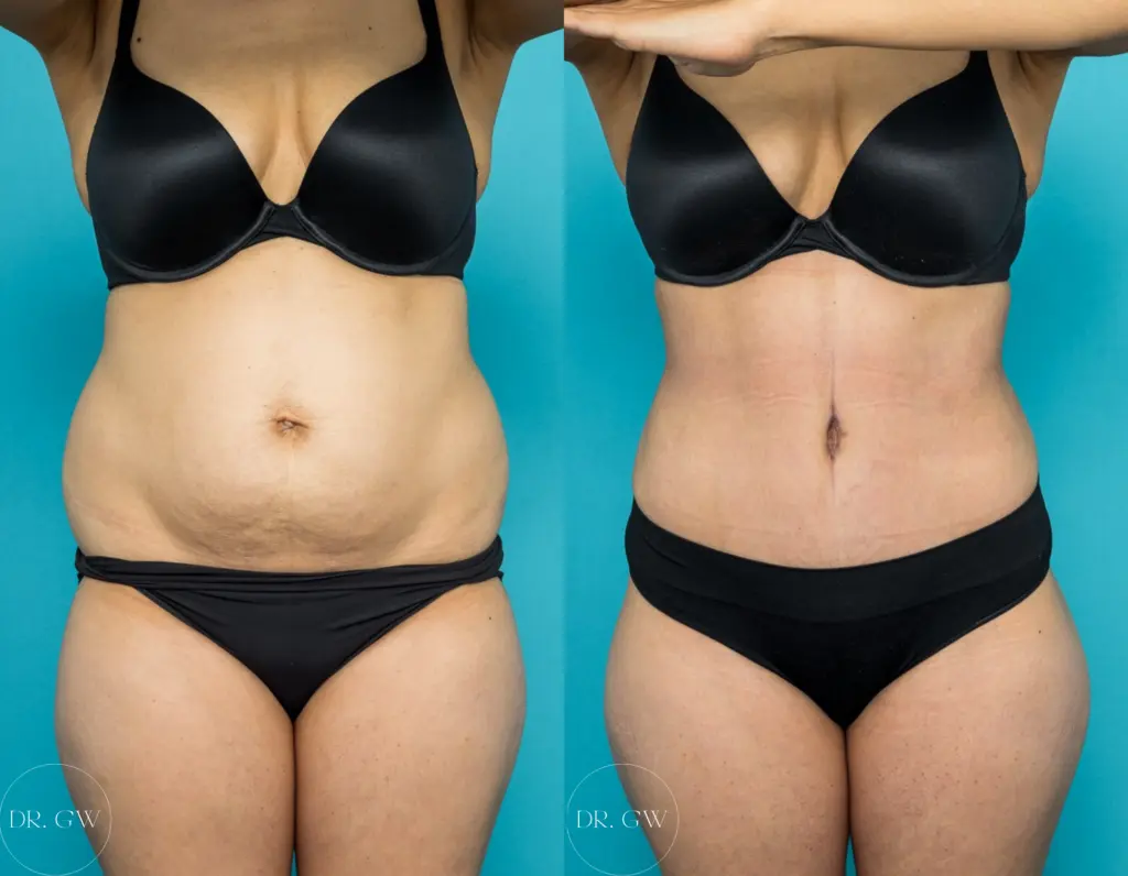 Different Types of Belly Fat Before and After Featured Image 6995 abdo 360 lipo 3 months F