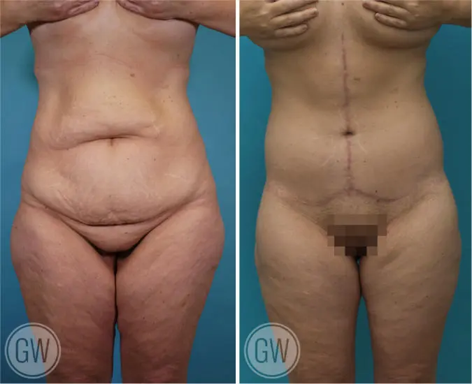 Abdominoplasty + Lower Back Lift Before and After image 