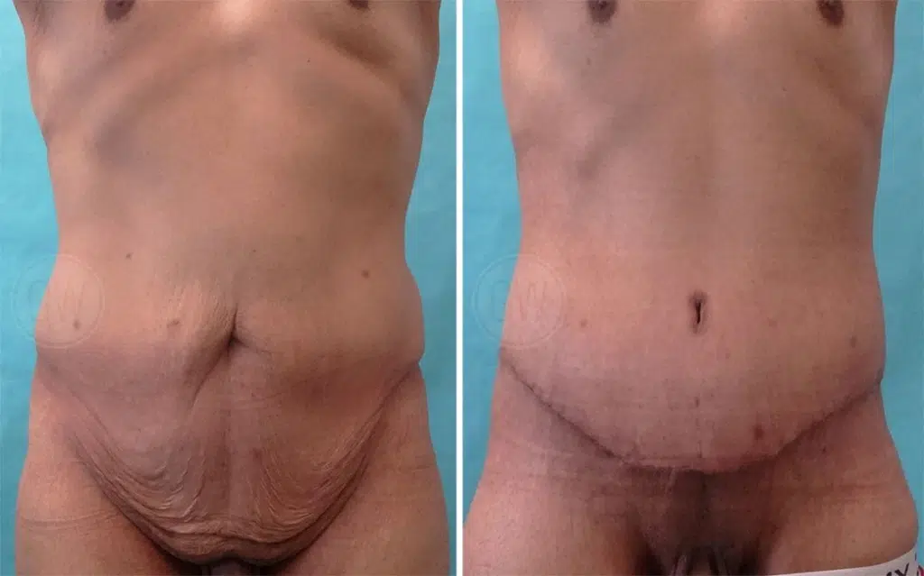 Body Lift Before and After Image 