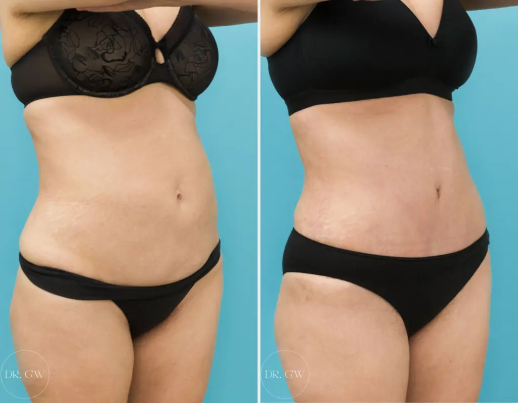 Abdominoplasty + 360 Liposuction Before and After Photos
