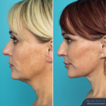 12 Months Post-op Deep Plane Face Lift, Neck Lift and Gliding Brow Lift