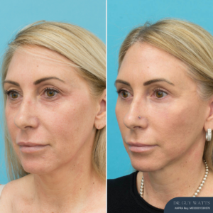 5 Months Post Face and Neck Lift + Upper and Lower Blepharoplasty