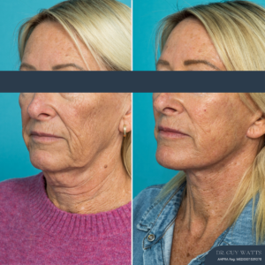 12 Months Post-op Deep Plane Face Lift, Neck Lift and Gliding Brow Lift + TCA Peel