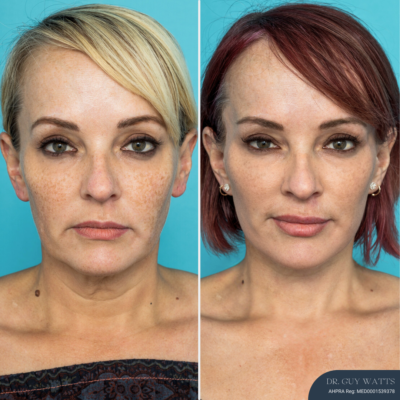 7345 - 12 Months Post-op Deep Plane Face Lift, Neck Lift and Gliding Brow Lift (4) 12 Months Post-op Deep Plane Face Lift, Neck Lift and Gliding Brow Lift
