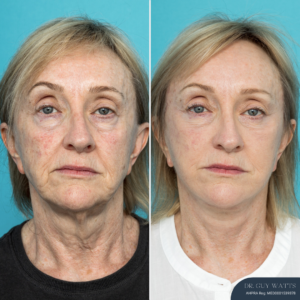 Post-op Face and Neck Lift