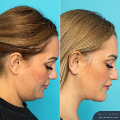7503 - 3 Months Post-op Anterior Neck Lift (2) 3 Months Post-op Anterior Neck Lift