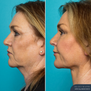 12 Months Post-op Deep Plane Neck Lift