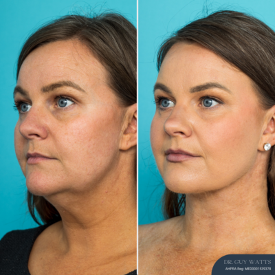 7808 - 3 months Post-op Neck Lift 3 months Post-op Neck Lift