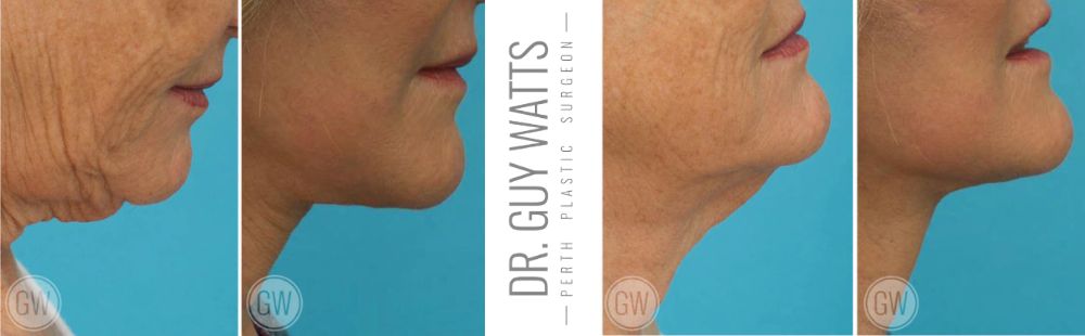 Guy Watts Necklift BA images - GW image