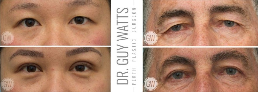 Guy watts - Guy Watts Upper Blepharoplasty BA images