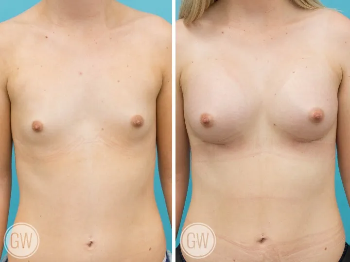 breast-implants-perth-10